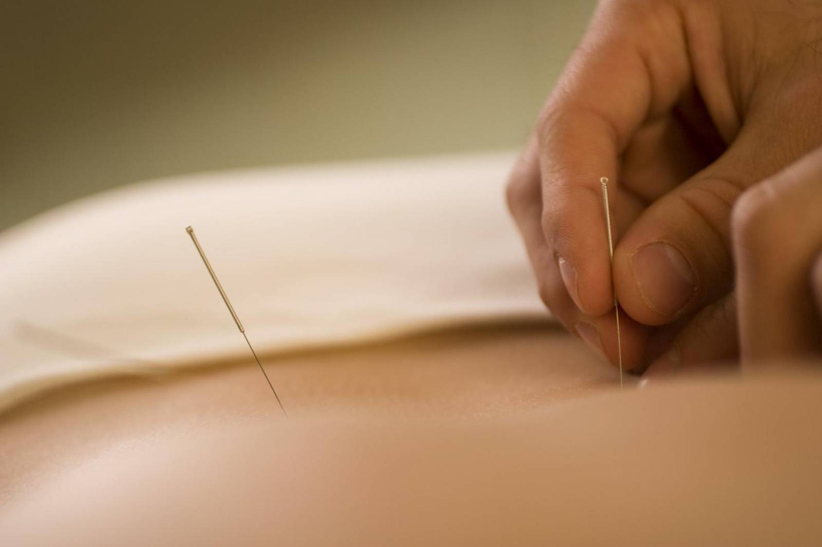 Perte de poids et acupuncture à Lyon