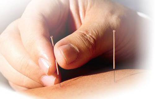 Prise de rdv pour une séance d'acupuncture à Lyon avec Vincent Bounpraseuth