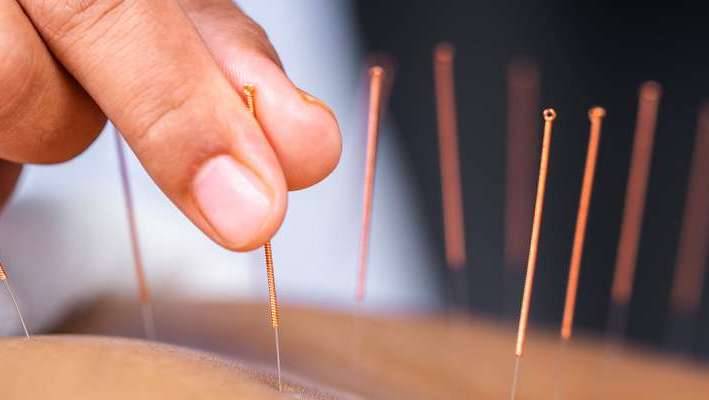 Accompagnement de la grossesse par l'acupuncture à Lyon dans le 69